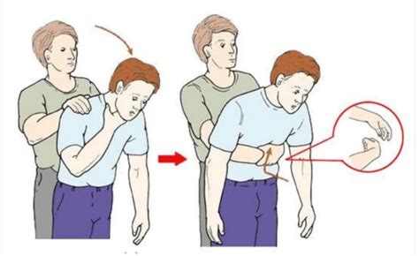 一目了然！海姆立克急救法详细图解 2