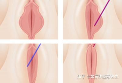 阴道紧缩术的相关信息或效果如何？ 1