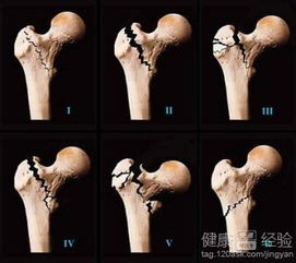 骨折恢复时期应该吃什么好？ 2