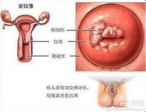 宫颈糜烂：揭秘那些不容忽视的症状表现 3