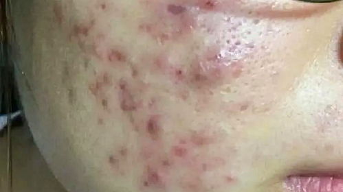 轻松掌握！简单去粉刺的有效方法 3