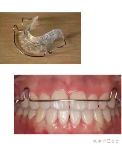 牙套保持器有哪些种类？ 3