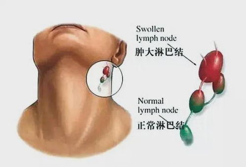 淋巴结肿大应该如何治疗？ 1