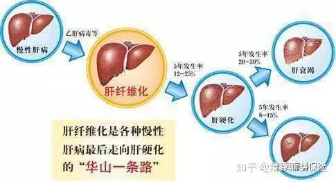 早期肝硬化：科学治疗方案，重拾健康之路 2