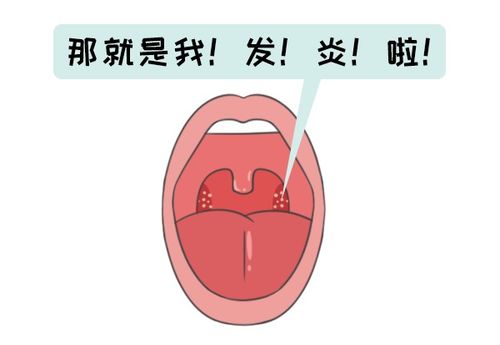 扁桃体发炎的有效应对措施 3