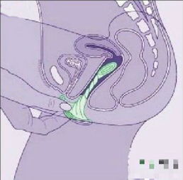 女性避孕套的巧妙使用方法 4