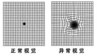 黄斑变性自查秘籍：如何用阿姆斯勒方格表进行自我检测？ 1