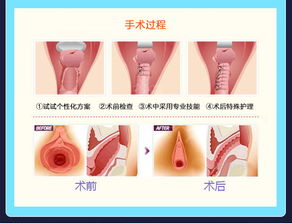 重塑紧致：了解阴道紧缩术 1