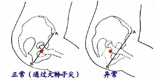 揭秘医学奇迹：深入探索Bryant三角的奥秘 3