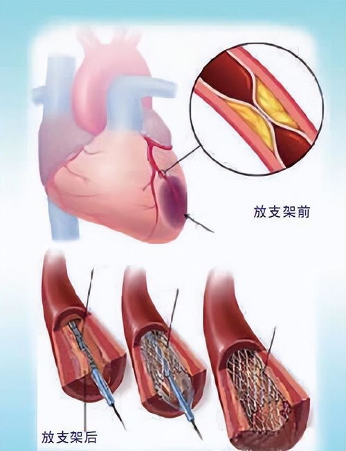 心脏支架手术后，患者的寿命能否重获新生？ 1