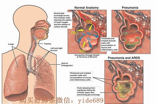 慢性支气管炎：有效治疗策略，重获呼吸自由 4