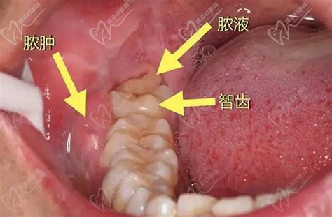 智齿发炎肿痛，快速解决方法来了！ 2