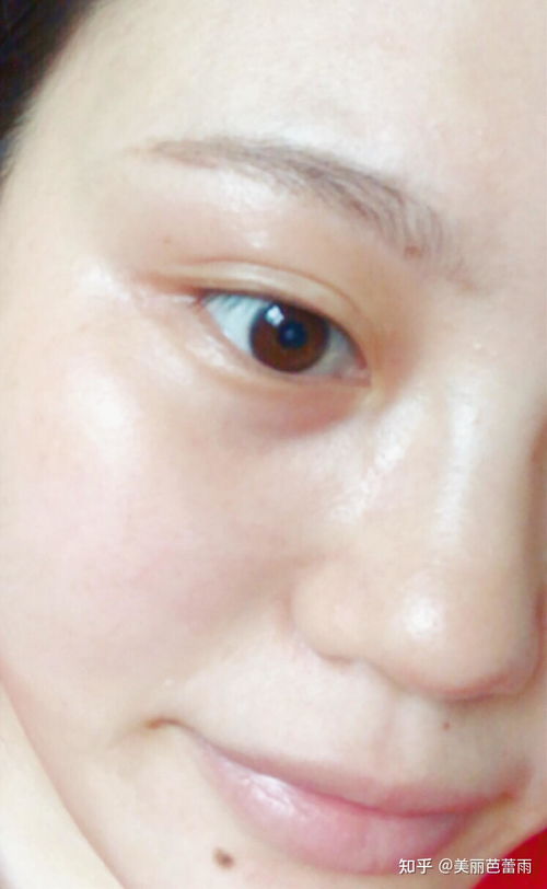 告别脸部红血丝，重拾健康美肌秘籍 3