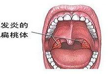 扁桃体发炎的有效应对措施 1