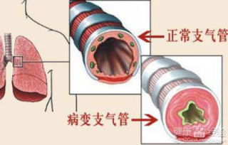 慢性支气管炎的有效治疗策略揭秘 3