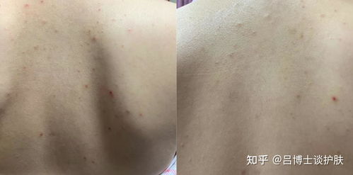 如何有效根治前胸后背痘痘，告别后背痘痕烦恼 3