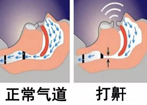 鼾声背后的隐忧：揭秘打鼾不容忽视的危害 2