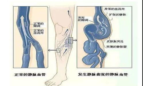 揭秘大隐静脉曲张：波氏(Perther)试验的神奇检查之旅 3