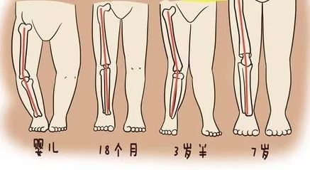 揭秘O型腿与罗圈腿的真相：你不可不知的腿型秘密 2