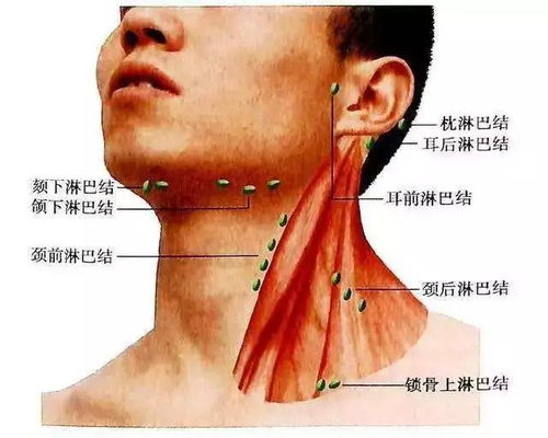 淋巴结肿大应该如何治疗？ 3