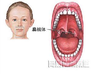 如何能够彻底根治扁桃体炎？ 2