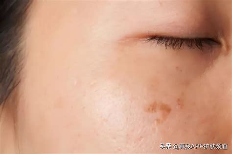 告别粗大毛孔，重拾肌肤细腻光泽的秘诀！ 2