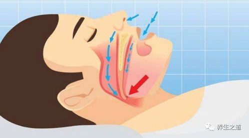 鼾声背后的隐忧：揭秘打鼾不容忽视的危害 3