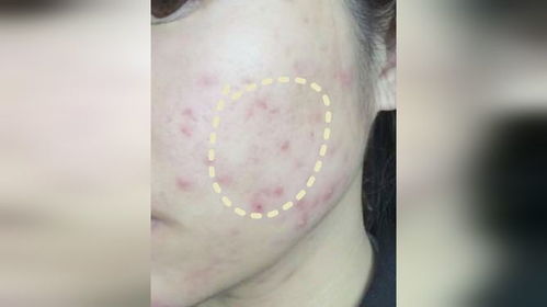 轻松掌握！简单去粉刺的有效方法 2