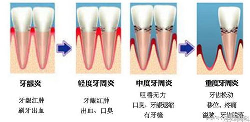 牙周炎能否被治愈？ 2