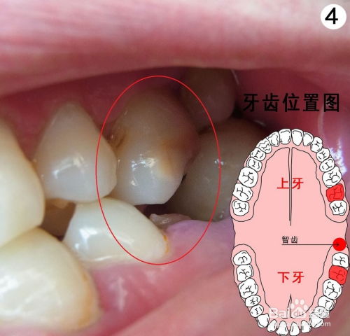 智齿牙龈发炎应对措施 2