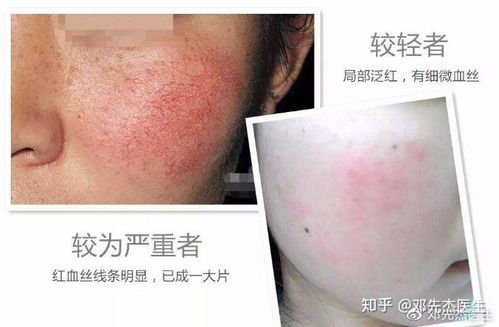 告别脸部红血丝，重拾健康美肌秘籍 2