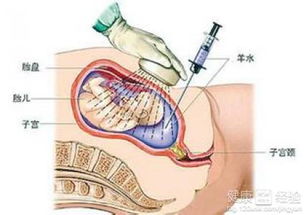 羊水穿刺操作流程与安全解析 2