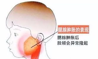 揭秘：高效守护健康，远离流行性腮腺炎的必备策略 4